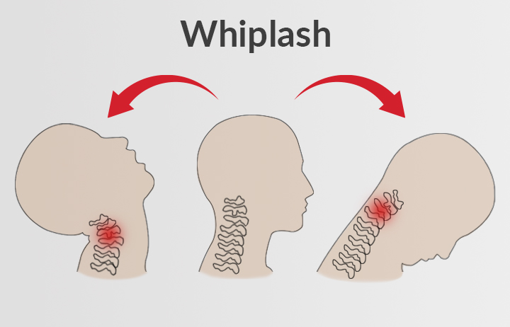 what-is-whiplash-injury-signs-and-treatment