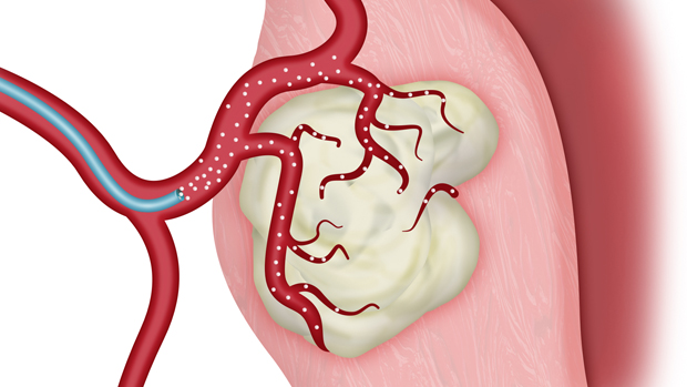 is-uterine-artery-embolization-the-right-treatment-for-you